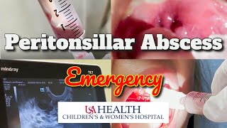 Tonsil Stone Removal  Tonsillolith removal by Dr Raman Dhungel [upl. by Beauregard468]