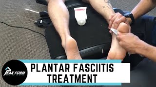 Plantar Fasciitis Treatment San Diego Graston Chiropractic [upl. by Eisnyl443]