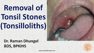 Tonsillitis Causes Signs and Symptoms Diagnosis and Treatment [upl. by Ennaul]