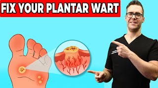 Plantar Warts Removal at Home Treatment Foot amp Toe Wart Remedies [upl. by Laehcym271]