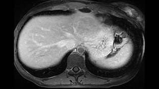 Focal nodular hyperplasia [upl. by Yemrej]