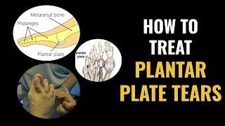 Plantar Plate Tears  How to treat them [upl. by Had]