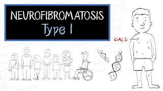 What is Neurofibromatosis Type 1 NF1 [upl. by Elleuqar]