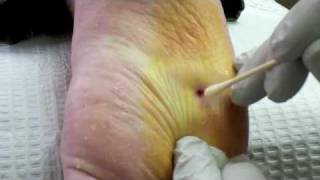 Surgical Plantar Wart Removal [upl. by Nasar]