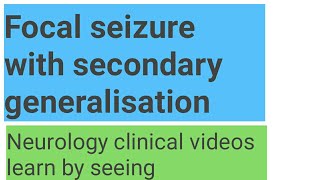 video to induce seizures [upl. by Attalie]