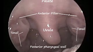 Tonsil Cyst White thing over tonsil Symptoms and management No antibiotics needed [upl. by Ytirahc]