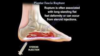 Plantar Fascia Rupture  Everything You Need To Know  Dr Nabil Ebraheim [upl. by Anerys822]