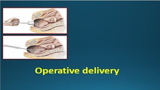 OPERATIVE DELIVERY  Instrumental deliveries Vacuum amp Forceps [upl. by Pelmas]