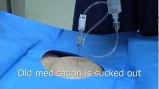 Intrathecal or Spinal Morphine pump or Baclofen pump refill procedure [upl. by Yasmine]