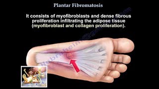 Plantar Fibromatosis  Everything You Need To Know  Dr Nabil Ebraheim [upl. by Donell]