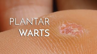 Plantar Warts Verrucas  Podiatrist Georgina Tay East Coast Podiatry [upl. by Otineb]