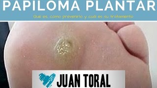 Papiloma plantar [upl. by Day]