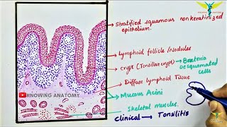 Peritonsillar Abscess Emergency and Needle Aspiration [upl. by Llatsyrk]