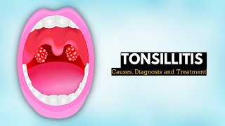 Tonsils  Clinical Anatomy Palatine lingual tubal adenoids [upl. by Morgun623]