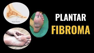 Plantar Fibroma [upl. by Kial]