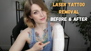 Laser Tattoo Removal Before amp After [upl. by Harrell]