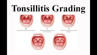 Tonsillitis Grading [upl. by Stephana]