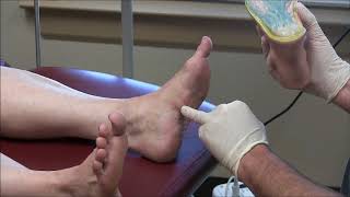 Painful Plantar Fibromas in Feet [upl. by Canice]