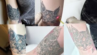 Laser Tattoo Removal Journey  BEFORE amp AFTERS [upl. by Aleiram]