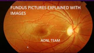 Fundus images explained by an ophthalmologist [upl. by Idoc]